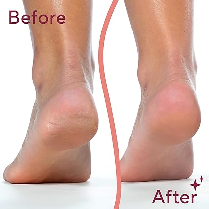Premium Callus Remover | مزيل الجلد الميت الفاخر – Foot File & Heel Scraper | مبرد القدم وكاشط الكعب لقدم ناعمة